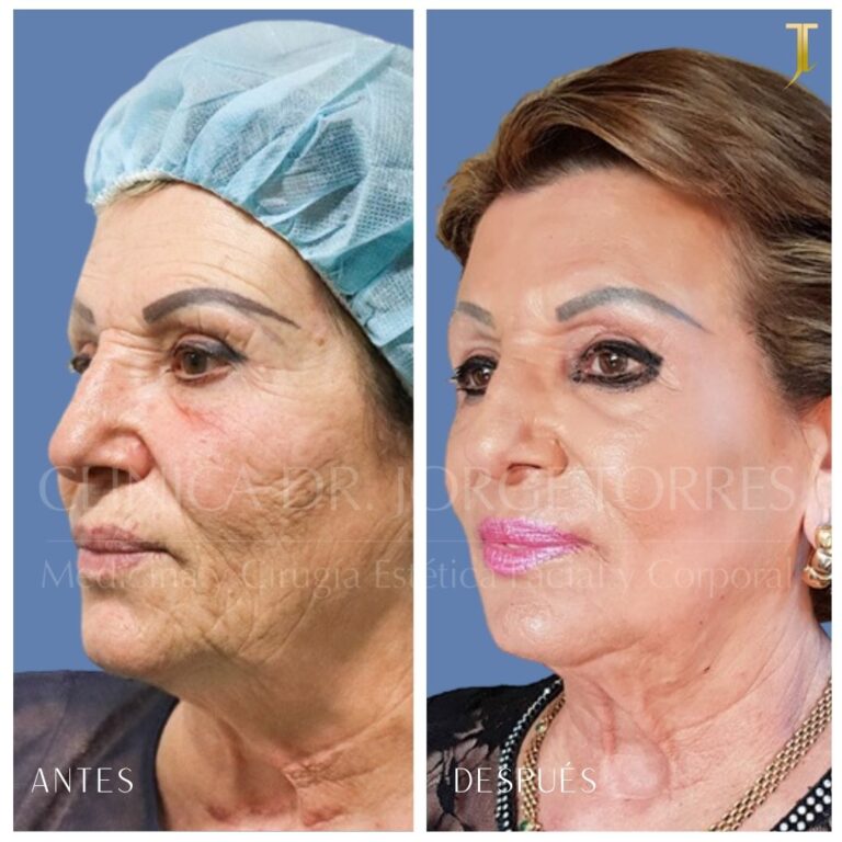 Lifting Deep Plane en Valencia